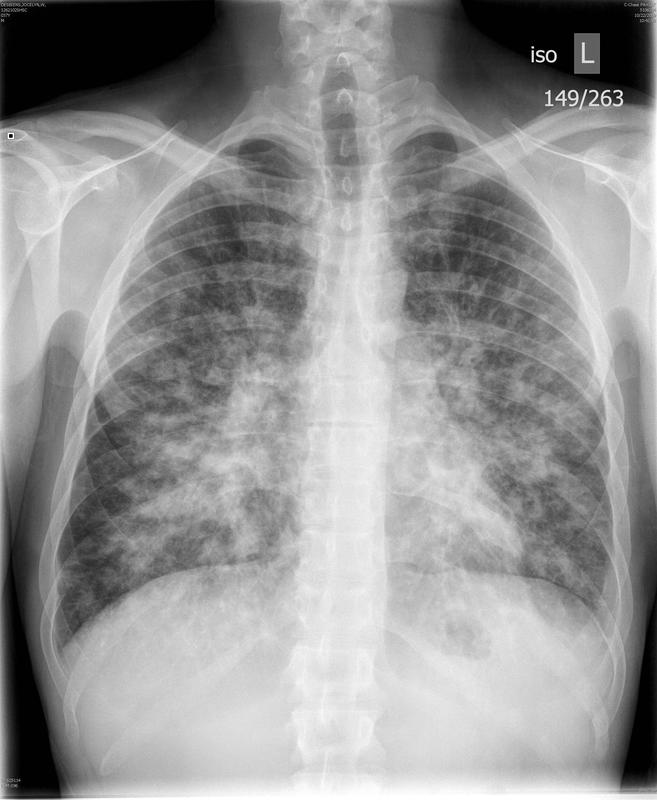 Kaposi's sarcoma