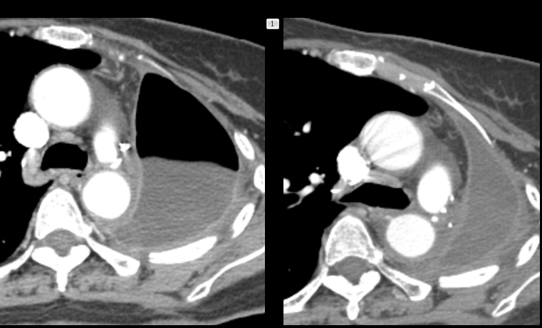 3 and 9 mo. post-pneumonectomy