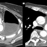 3 and 9 mo. post-pneumonectomy