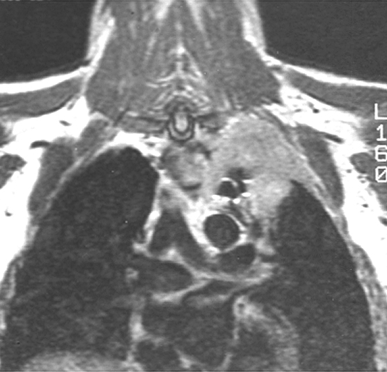 Pancoast Case 3 MRa