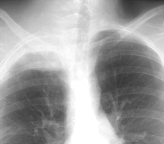 Pancoast Case 4 closeup