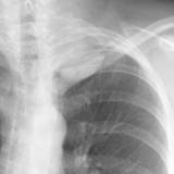 Pancoast Case 6 closeup