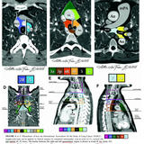 IASLC Clinical CT staging 
(7th proposed TNM class'n)