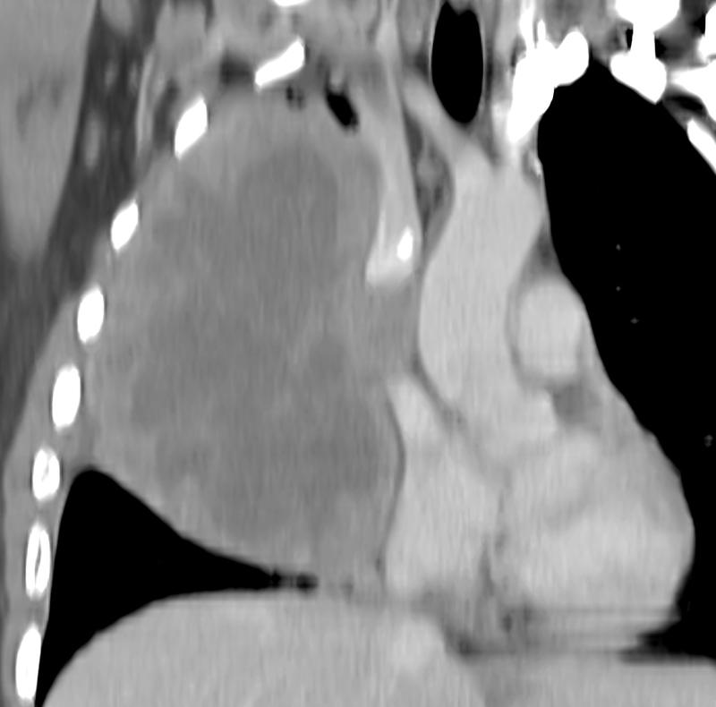 Lymphoma CT