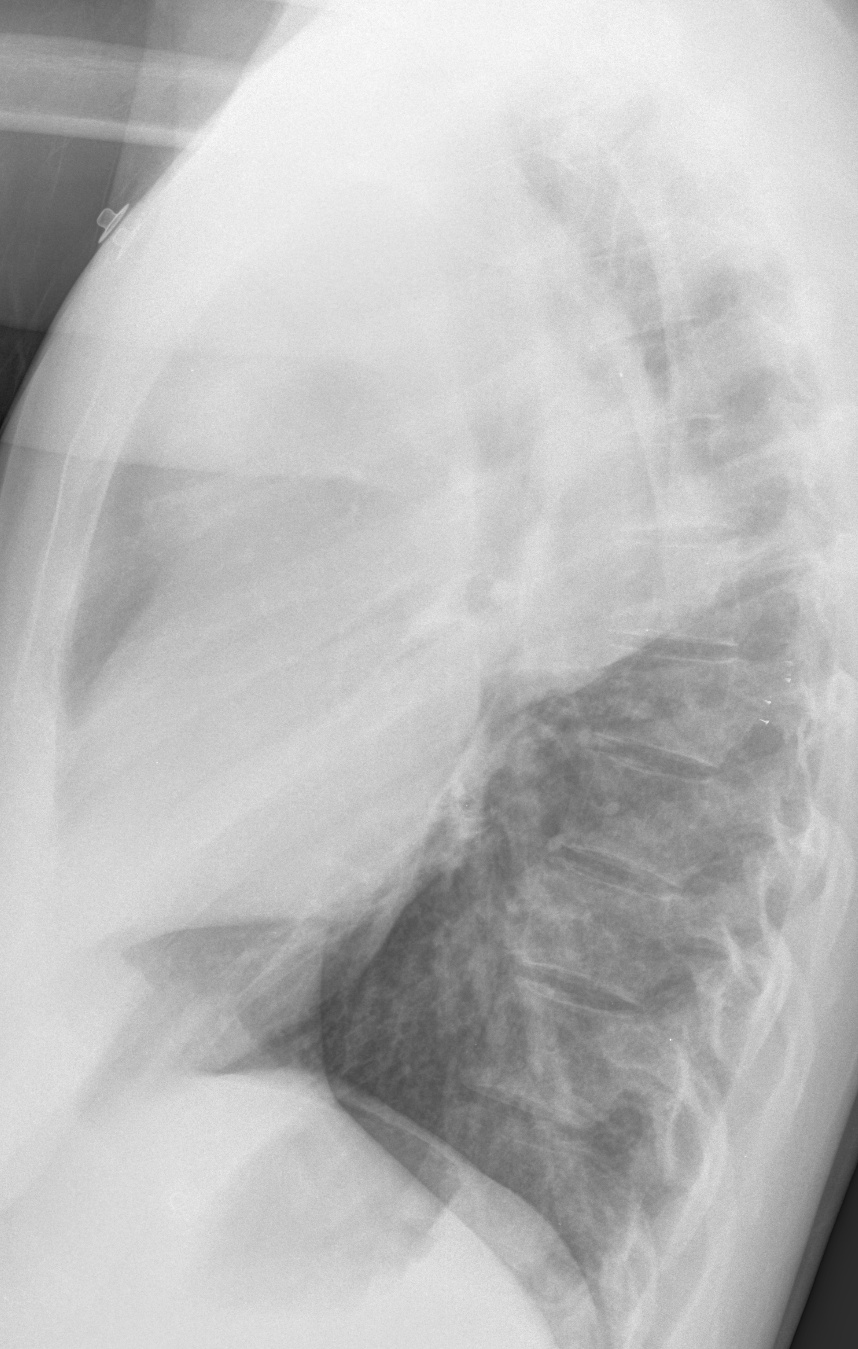 Lymphoma Lat