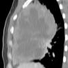 Lymphoma CT Sag