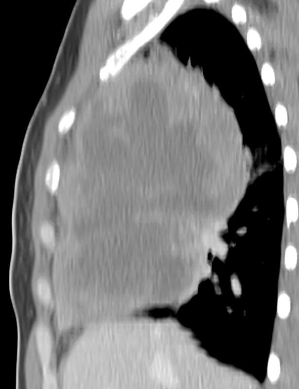 Lymphoma CT Sag