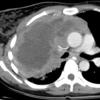 Lymphoma axial CT