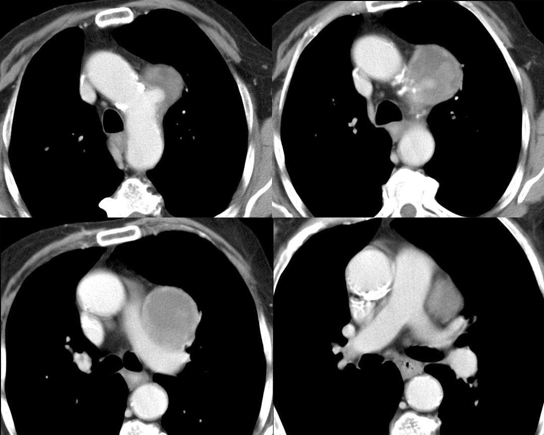 Ao Aneurysm 1c