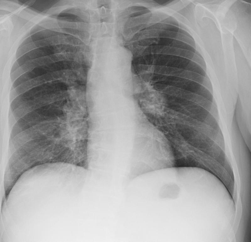 Lymphoma   Nodes and splenomegaly