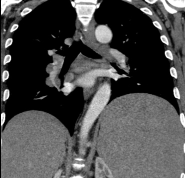 Lymphoma  coronal CT