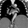 Lymphoma  coronal CT