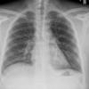 Lymphoma -Mediastinal and left axillary nodes (see CT)