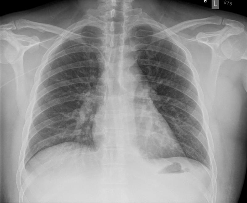 Lymphoma -Mediastinal and left axillary nodes (see CT)