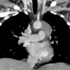 Lymphoma -Mediastinal and left axillary nodes