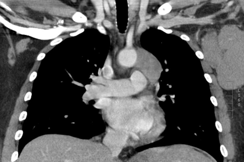 Lymphoma -Mediastinal and left axillary nodes