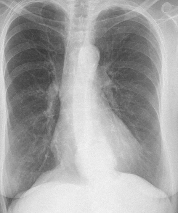 Hiatus Hernia
Case 2 PA