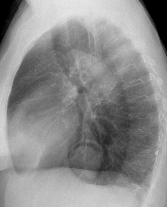 Hiatus Hernia
Case 2 Lat