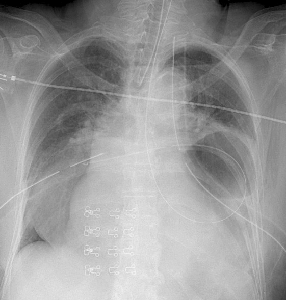 Hiatus Hernia
Case  3 (see CT)