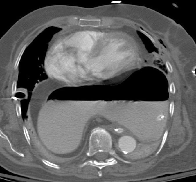 Hiatus Hernia
Case 3 CT