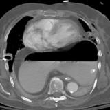 Hiatus Hernia
Case 3 CT