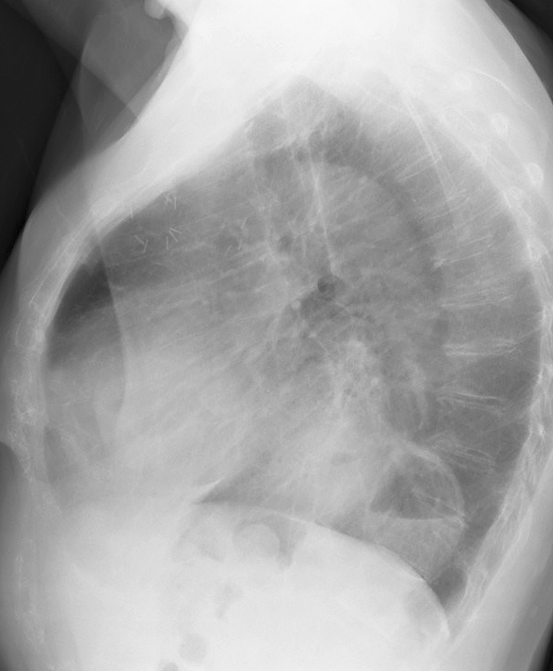 Hiatus Hernia
Case 4 Lat