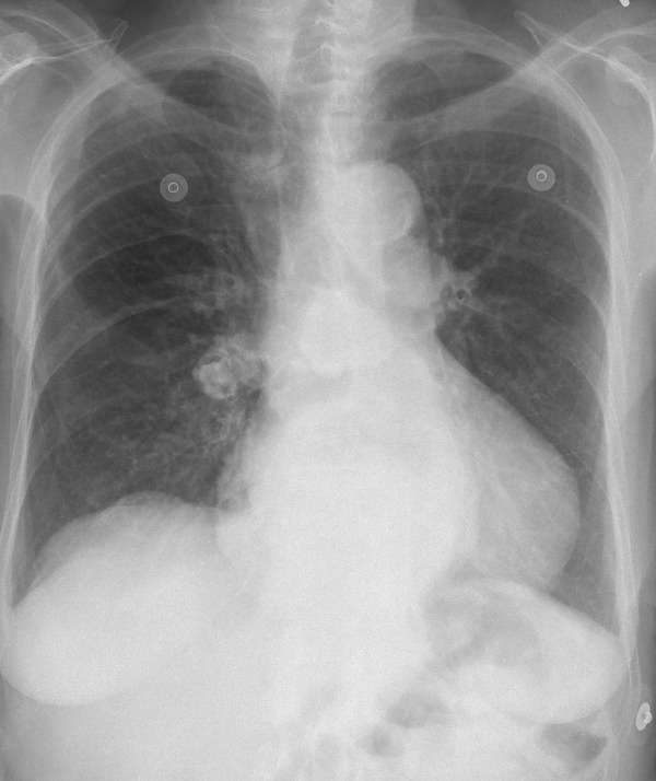 Hiatus Hernia
Case 5 PA