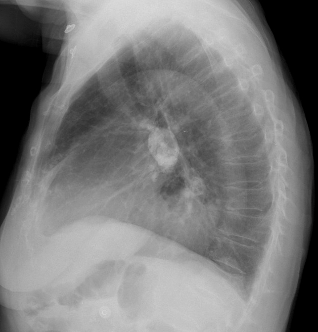 Hiatus Hernia
Case 5 Lat