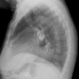 Hiatus Hernia
Case 5 Lat