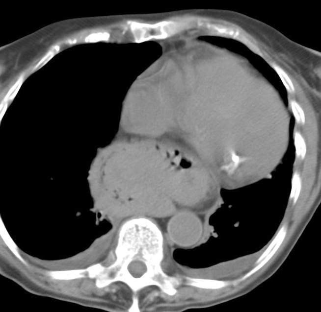 Hiatus Hernia
Case 5 CT