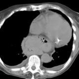 Hiatus Hernia
Case 5 CT