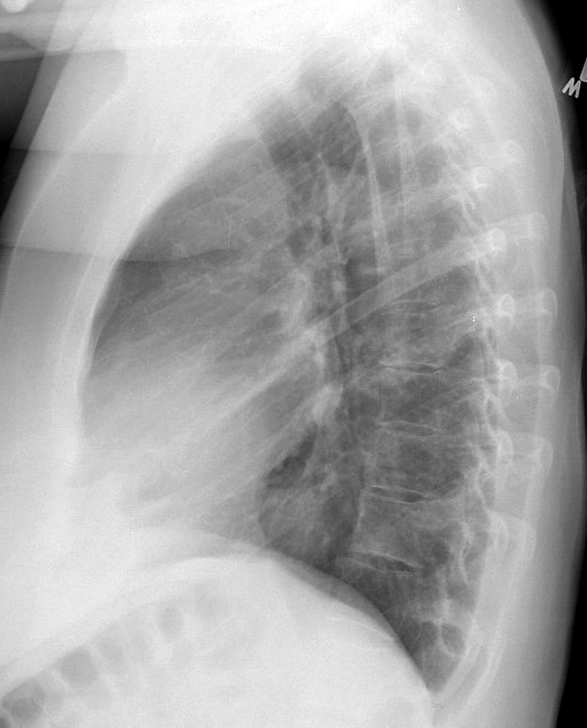 Hiatus Hernia
Case 6 Lat