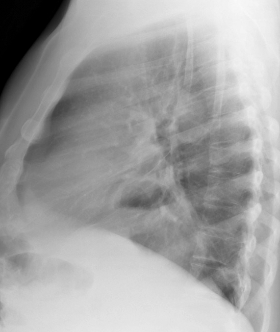 Hiatus Hernia
Case 7 Lat