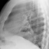 Hiatus Hernia
Case 7 Lat