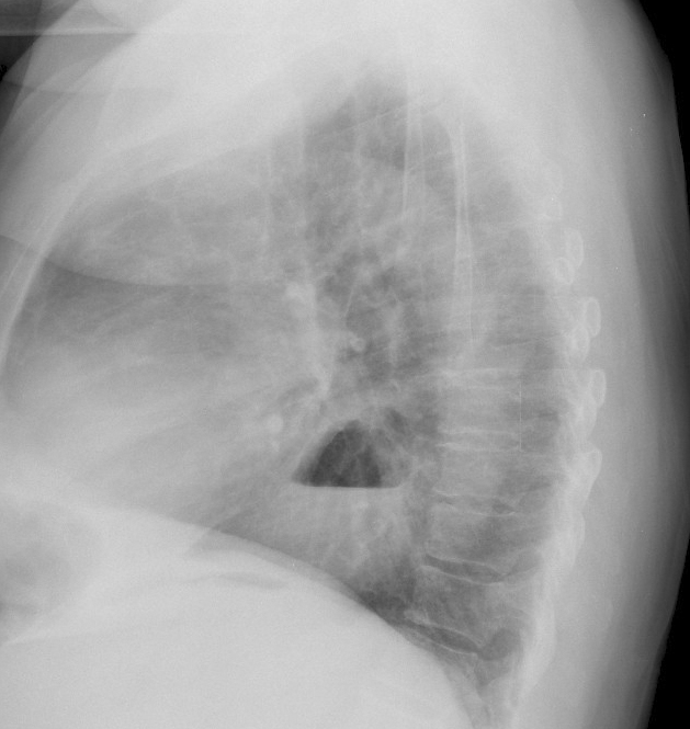 Hiatus Hernia
Case 8 Lat