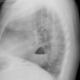 Hiatus Hernia
Case 8 Lat