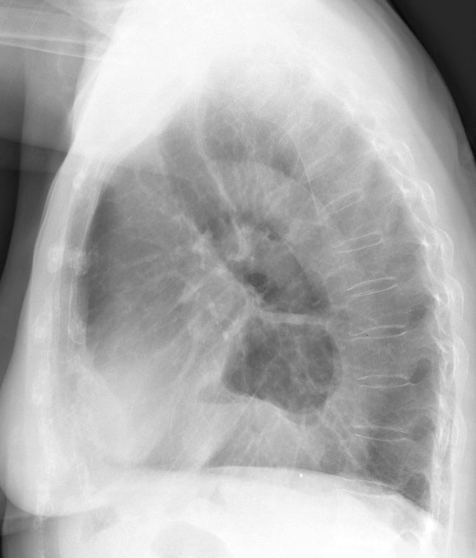 Hiatus Hernia
Case 9 Lat