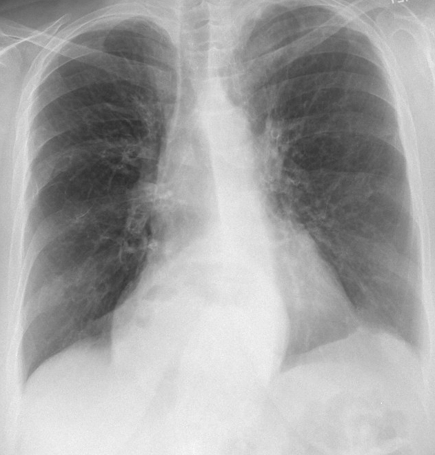 Hiatus Hernia
Case 10 PA only
(see CT)