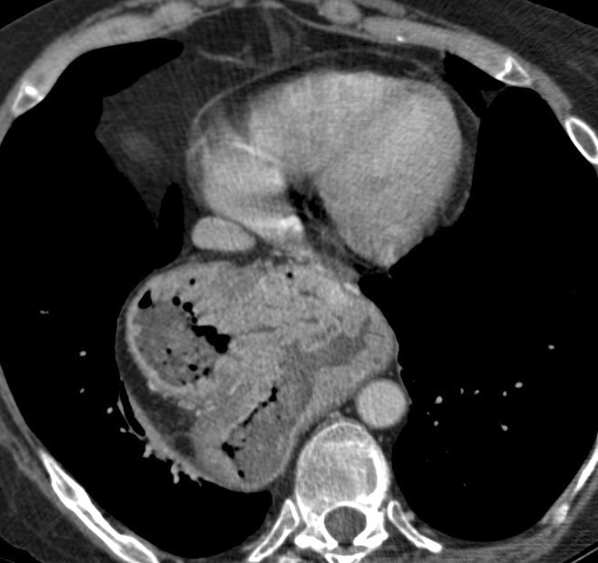 Hiatus Hernia
Case 10 CT