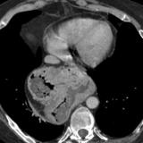 Hiatus Hernia
Case 10 CT