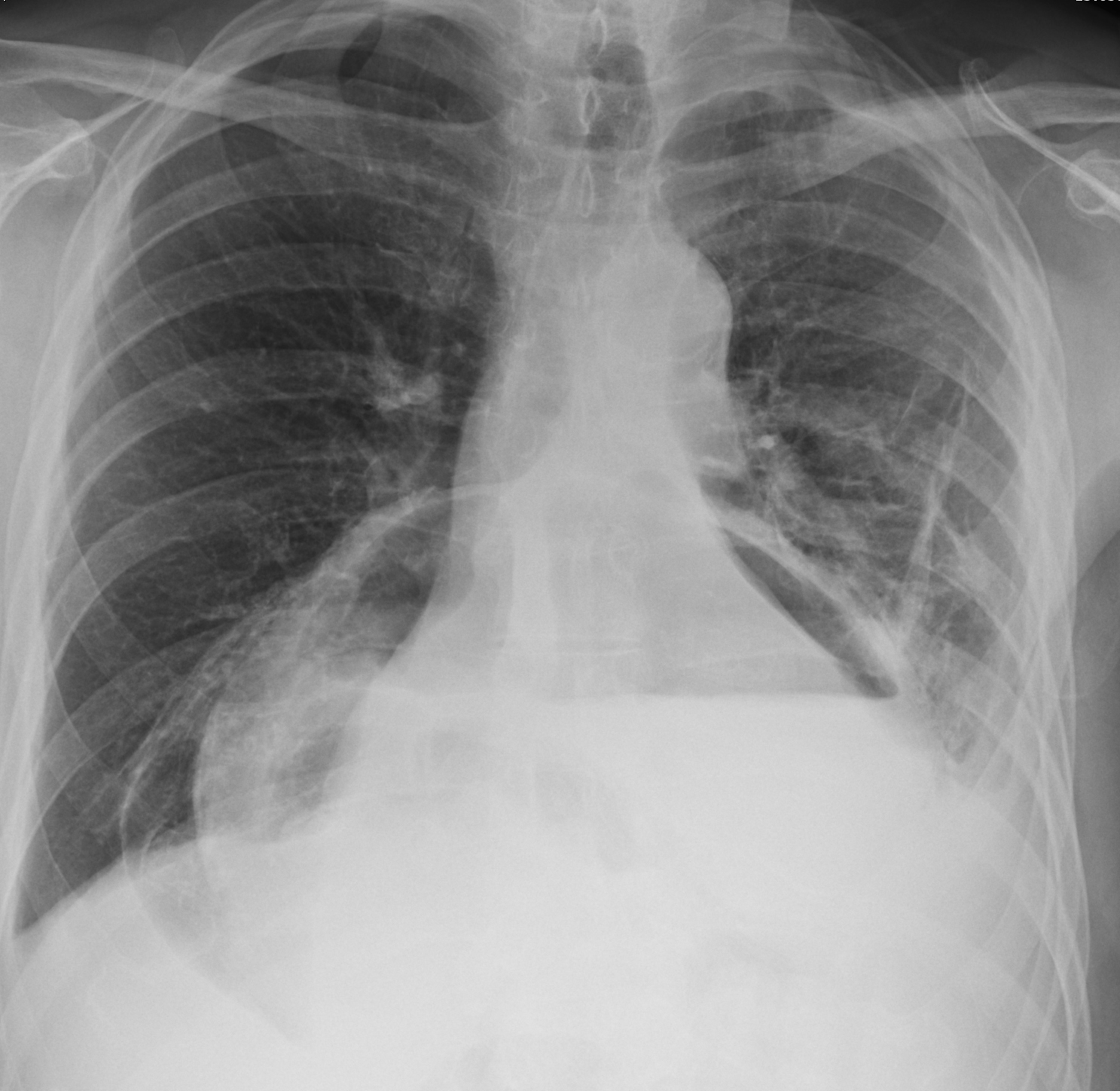 Hiatus hernia containing
stomach and transv colon