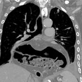 Hiatus hernia containing 
stomach and transverse colon