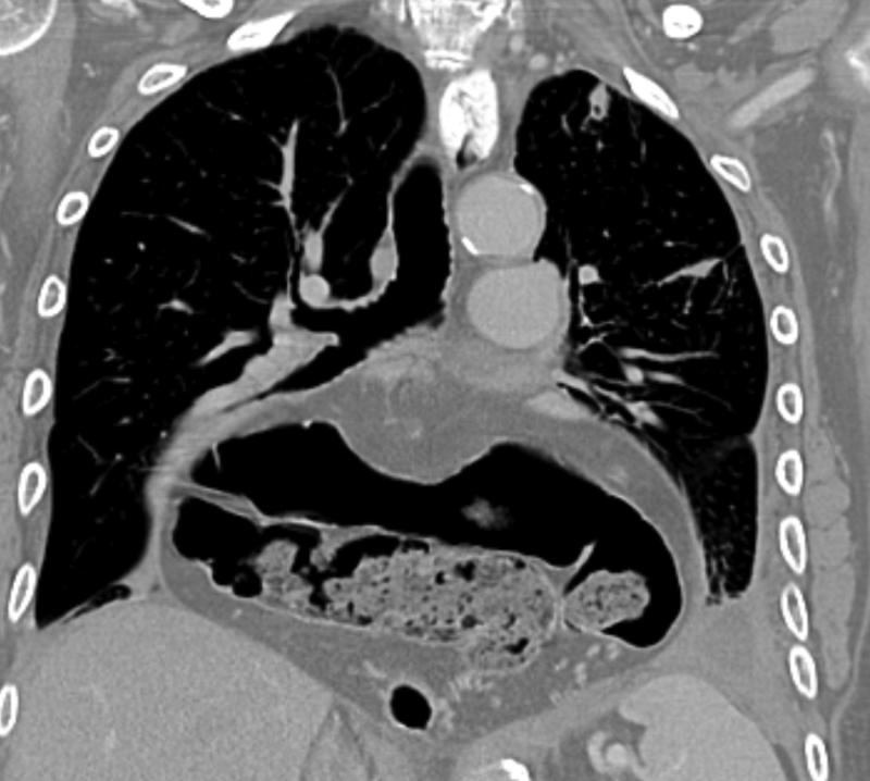 Hiatus hernia containing 
stomach and transverse colon