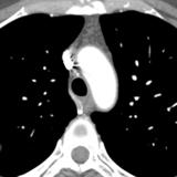 resid thymus