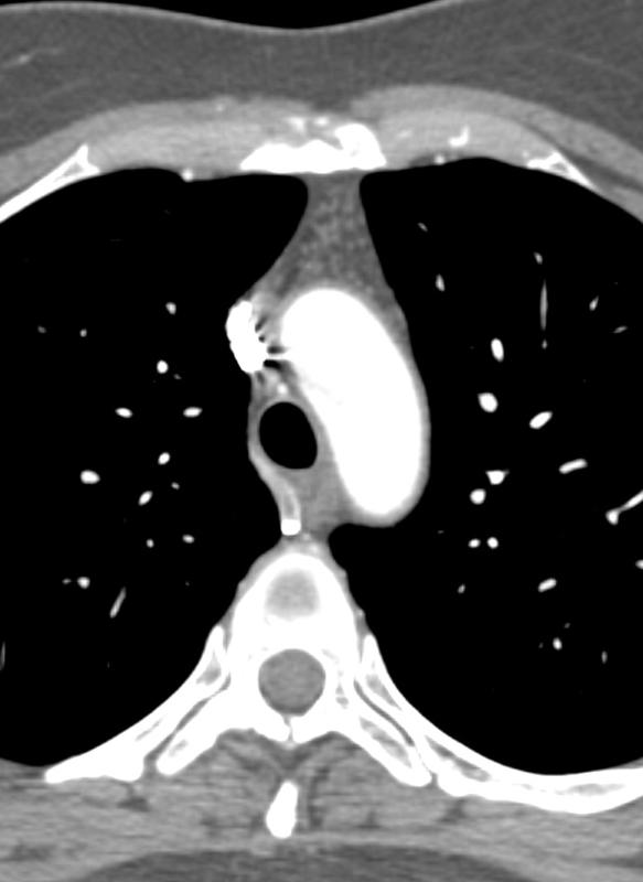 resid thymus