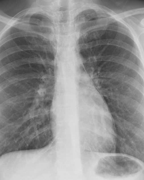 Pneumomediastinum 1