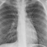 Pneumomediastinum 1