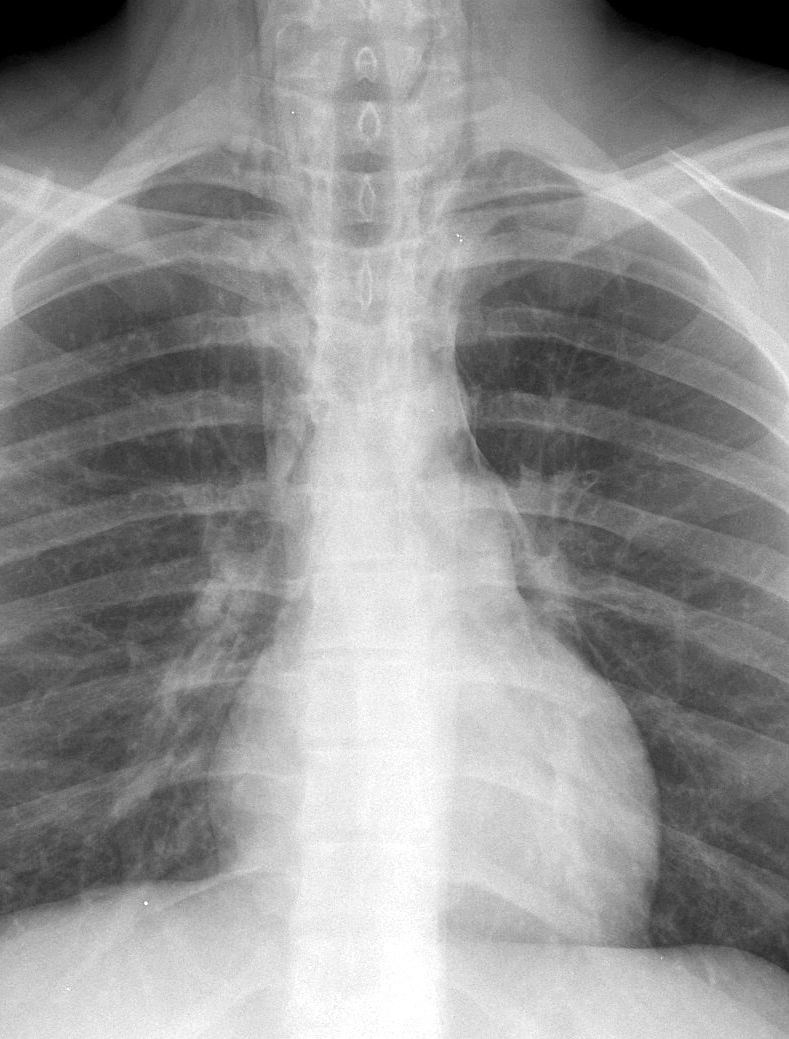 Pneumomediastinum 2