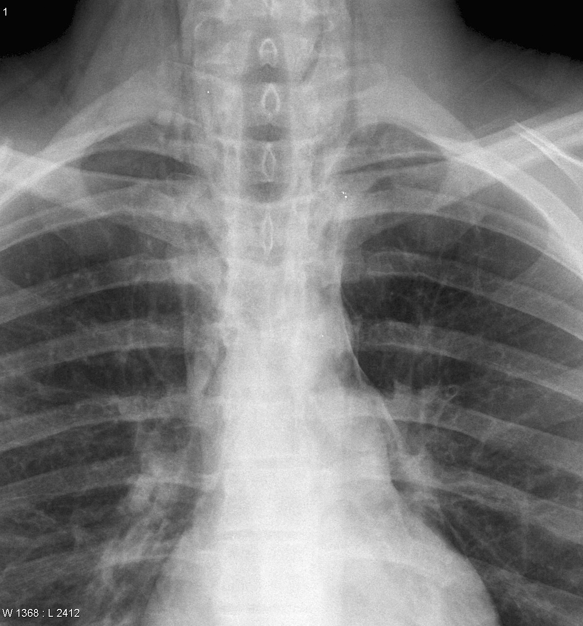 Pneumomediastinum cu