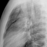 Pneumomediastinum 2 lat